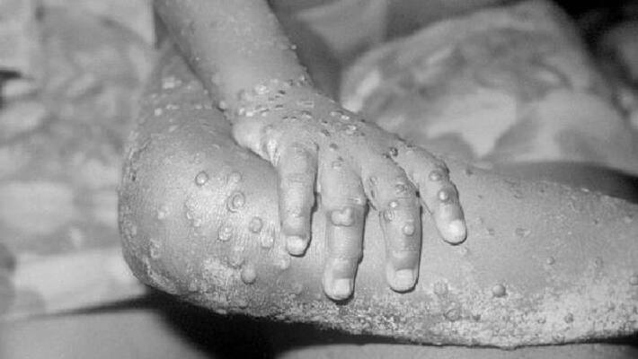 Monkeypox case reported in US after 18 years, check its symptoms and other details bpsb Monkeypox case reported in US after 18 years, check its symptoms and other details bpsb