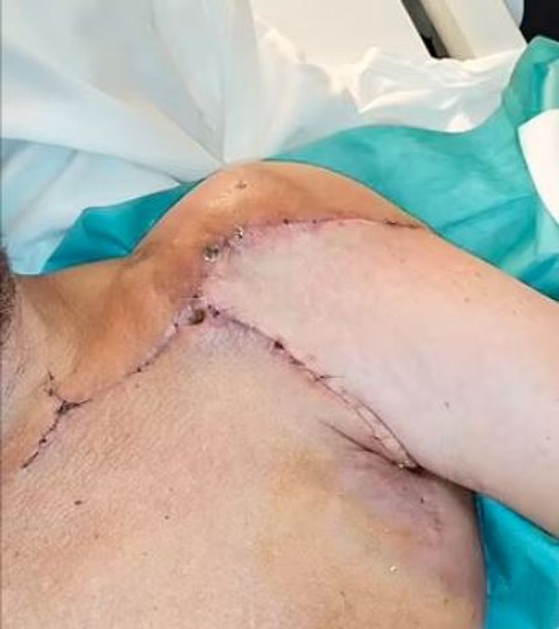 iceland world first surgery where man got his both hands transplanted kpn