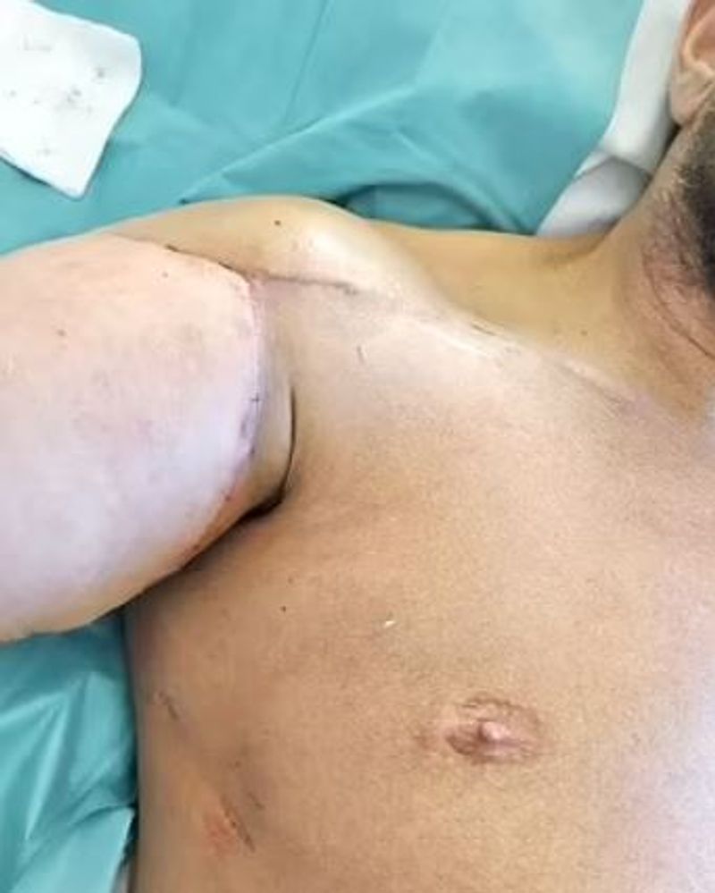 iceland world first surgery where man got his both hands transplanted kpn