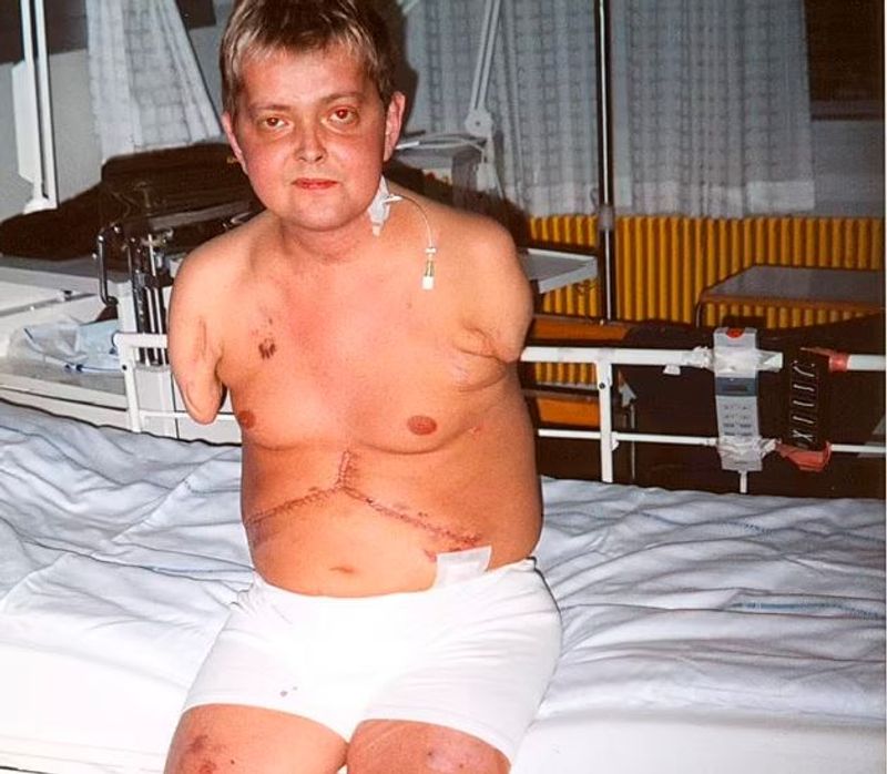 iceland world first surgery where man got his both hands transplanted kpn