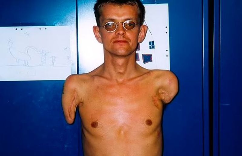 iceland world first surgery where man got his both hands transplanted kpn