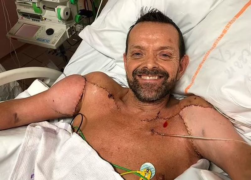 iceland world first surgery where man got his both hands transplanted kpn
