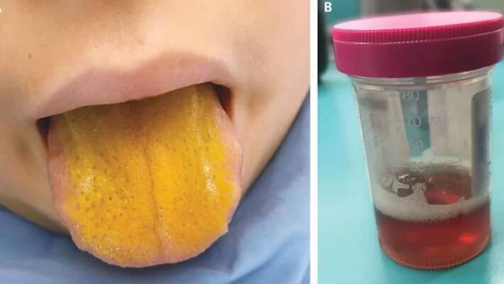 12 year old boy with bright yellow tongue diagnosed with rare disorder in Canada pod 12 year old boy with bright yellow tongue diagnosed with rare disorder in Canada pod