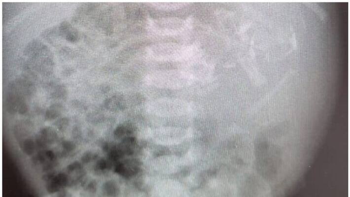 Girl born in Israel with twin inside her stomach Girl born in Israel with twin inside her stomach