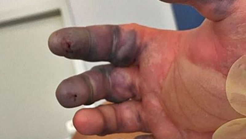 Spain man get his two fingers amputated due to a spider bite in Ibiza