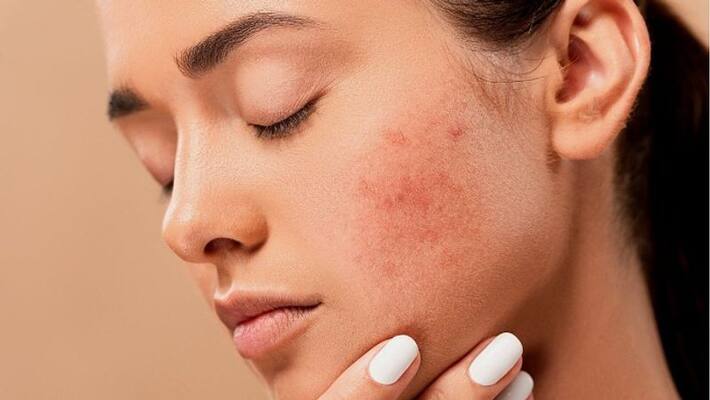 use these face packs to remove pimple marks use these face packs to remove pimple marks