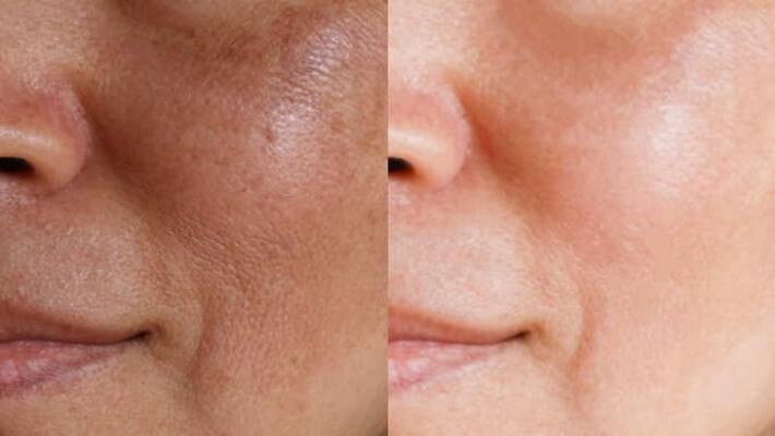 few remedy for open pores few remedy for open pores