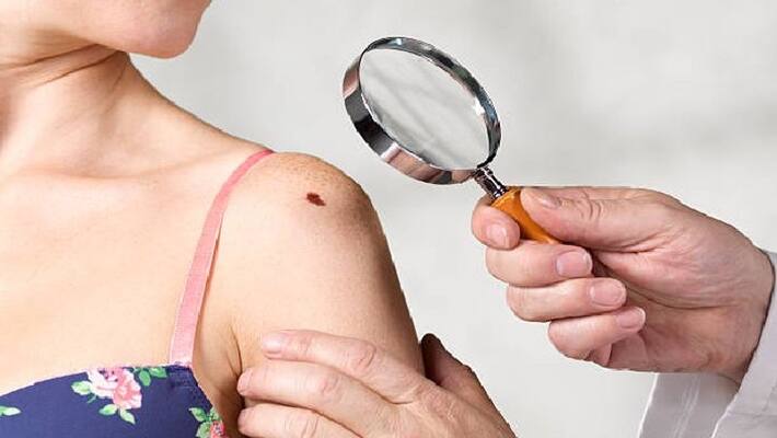 Danger can come if there are moles in these parts of body bpsb Danger can come if there are moles in these parts of body bpsb