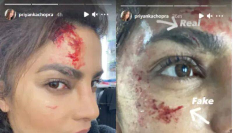 Priyanka Chopra gets hurt on the sets of Citadel shares pics of her wound dpl