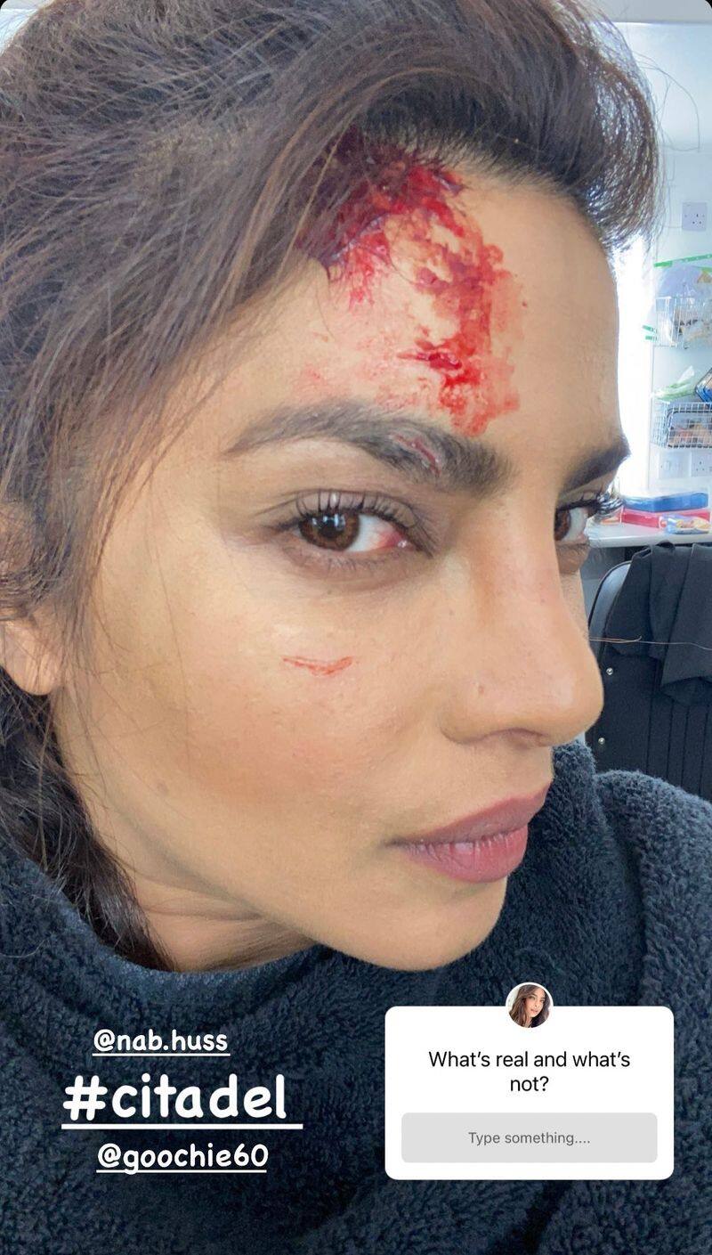 Priyanka Chopra injured while acting in action scene