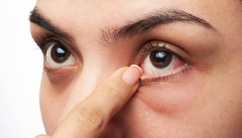 Is WFH stressing your eyes? Watching mobile phone hurting your eyes? Here are 8 tips to reduce the eye strain RCB