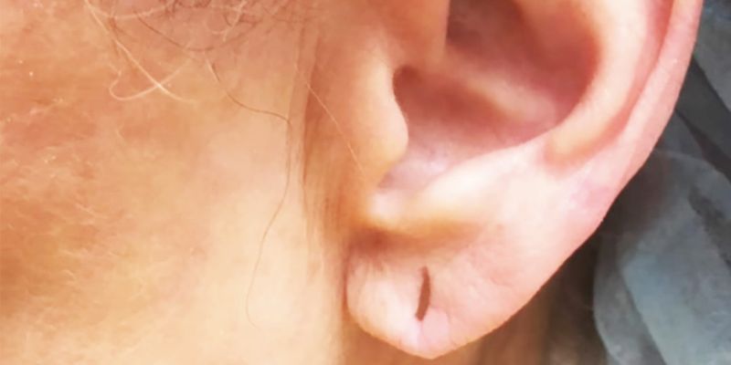 Migraine pain will be reduced by using ear rings bpsb