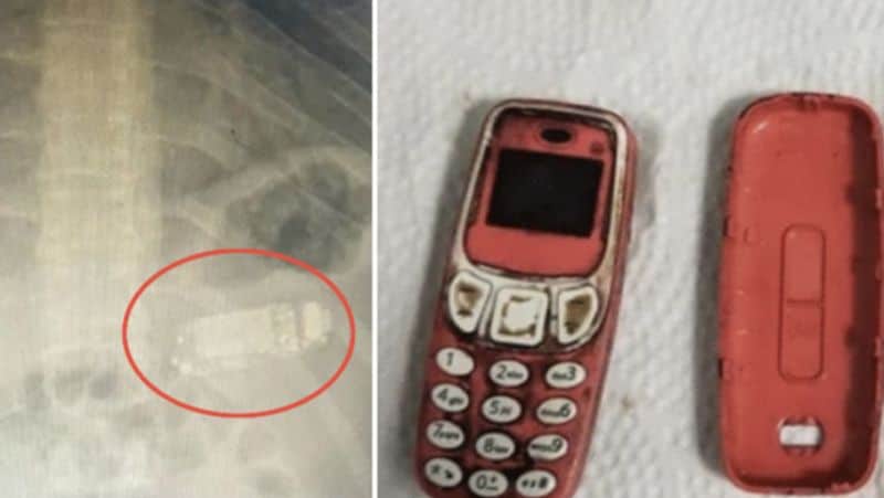 Kosovo a person swallowed a whole Nokia mobile