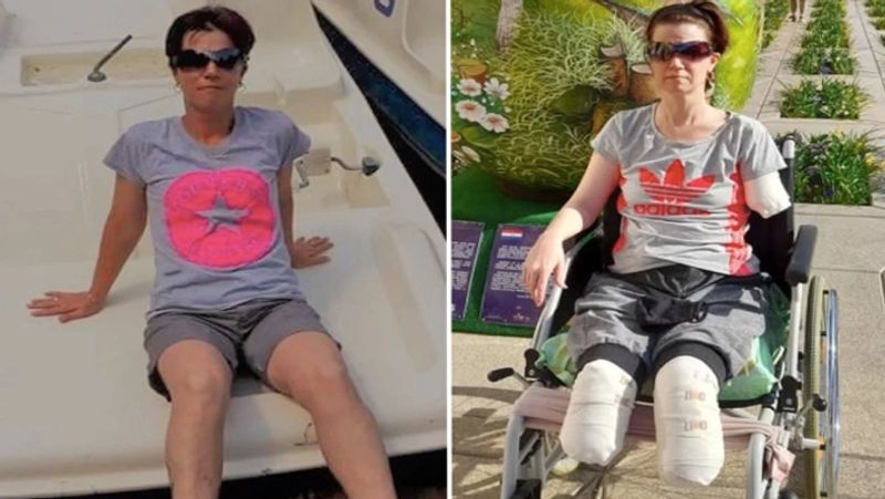 Hungary woman suffered a stomach ache but got her both feet and hands amputated