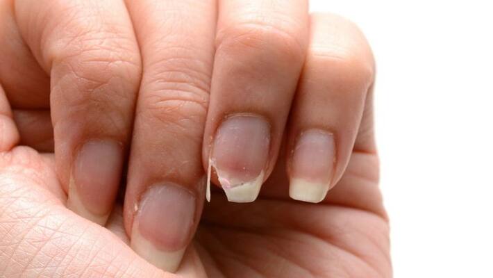 Nails break when they are big be careful it is a sign of a serious illness BDD Nails break when they are big be careful it is a sign of a serious illness BDD