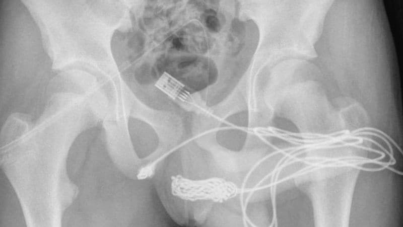 Weird news London 15-year-old boy inserted a USB cable inside his body to measure the length of his penis