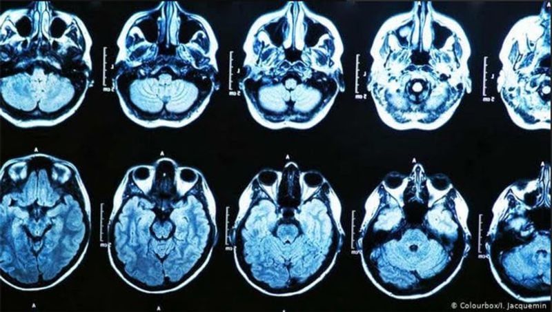 Strange and mysterious illness called Havana syndrome reports in India
