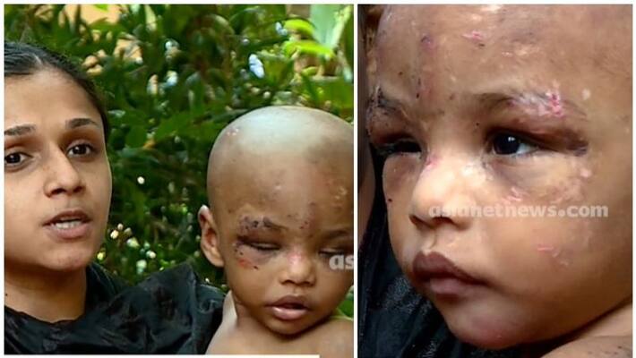 A one and a half year old boy with wounds all over his body A one and a half year old boy with wounds all over his body