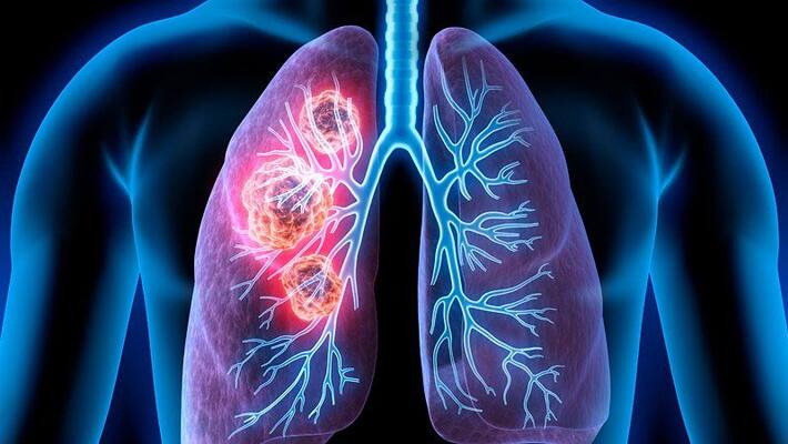 Lung cancer Symptoms and causes Lung cancer Symptoms and causes