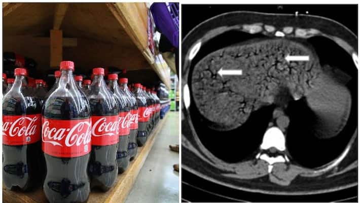 youth dies after gulping 1.5 litres of coca cola in 10 minutes says doctors in china youth dies after gulping 1.5 litres of coca cola in 10 minutes says doctors in china