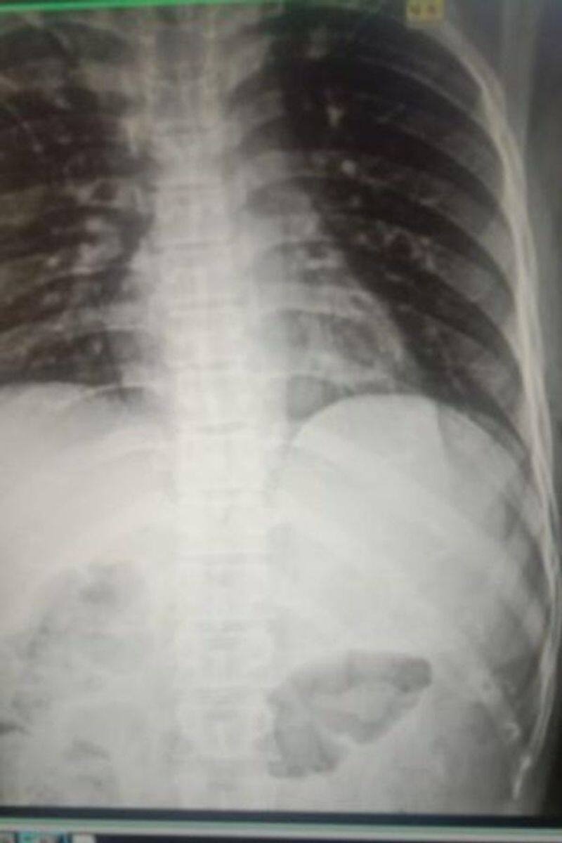 man complains cat scratched, doctors remove bullet from his rib cage