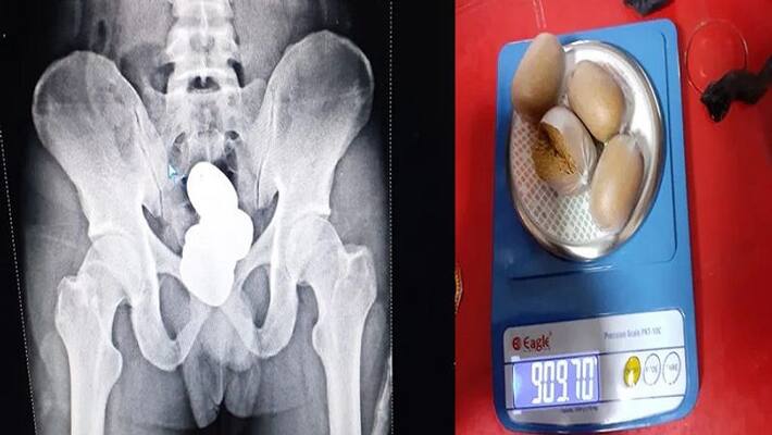 Man Hides Gold Paste Worth Rs. 42 Lakh In Rectum, Caught At Imphal Airport Man Hides Gold Paste Worth Rs. 42 Lakh In Rectum, Caught At Imphal Airport
