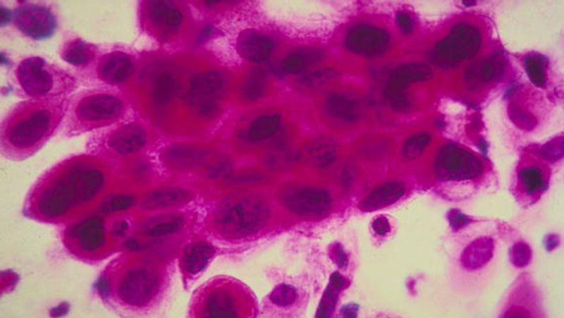 uk GenesisCare a specialist global cancer care provider studied breast cancer