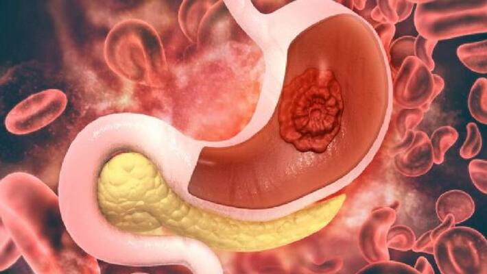 These are the early symptoms of stomach cancer know the cause of this disease BDD These are the early symptoms of stomach cancer know the cause of this disease BDD