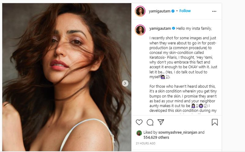 Actress Yami Gautam Opens Up About Her Skin Condition Keratosis Pilaris dpl