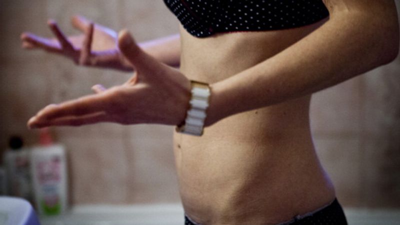 Anorexia girl so weak that her heart beat only 32 times in a minute