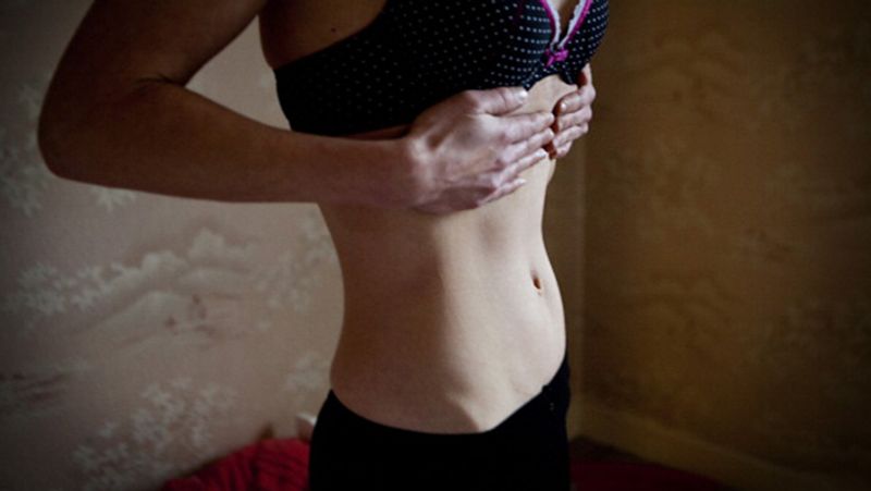 Anorexia girl so weak that her heart beat only 32 times in a minute