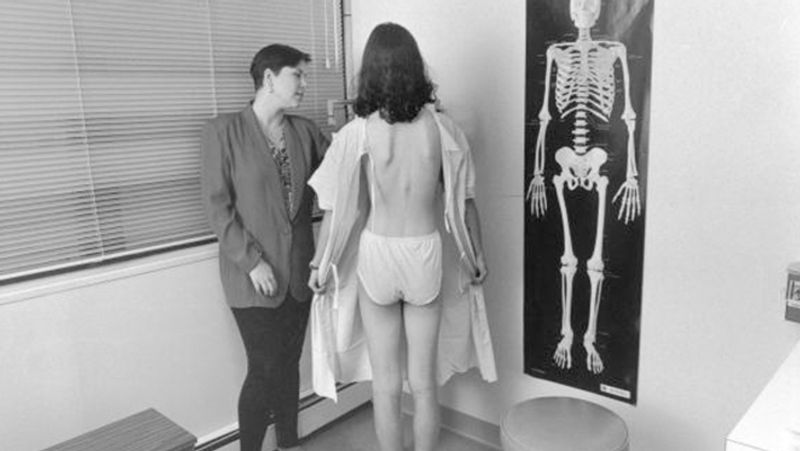 Anorexia girl so weak that her heart beat only 32 times in a minute