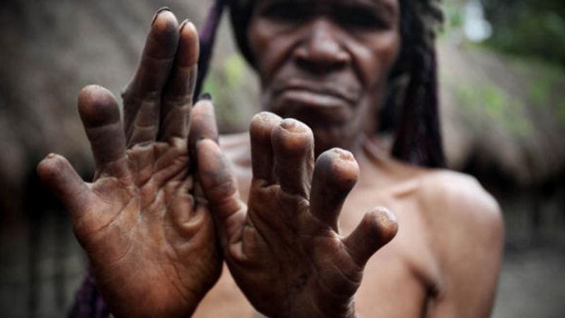 Indonesia Dani Tribes wife fingers are cut off in the death of her husband