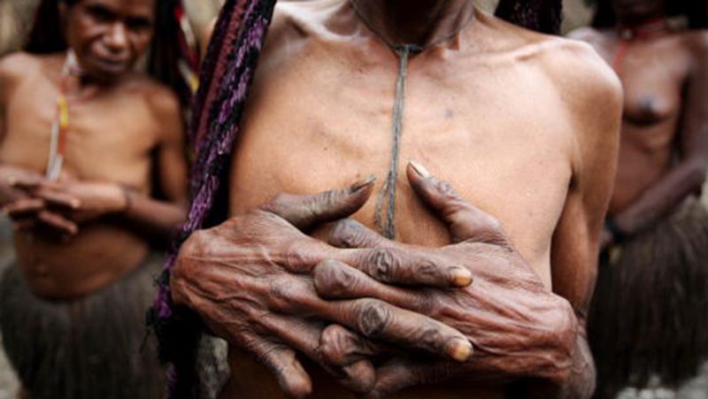 Indonesia Dani Tribes wife fingers are cut off in the death of her husband