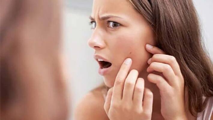how to remove pimple scars how to remove pimple scars