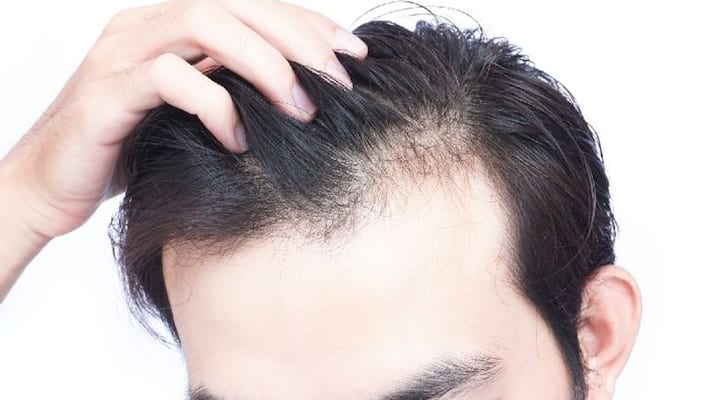 reasons behind male baldness 20s and early 30s reasons behind male baldness 20s and early 30s