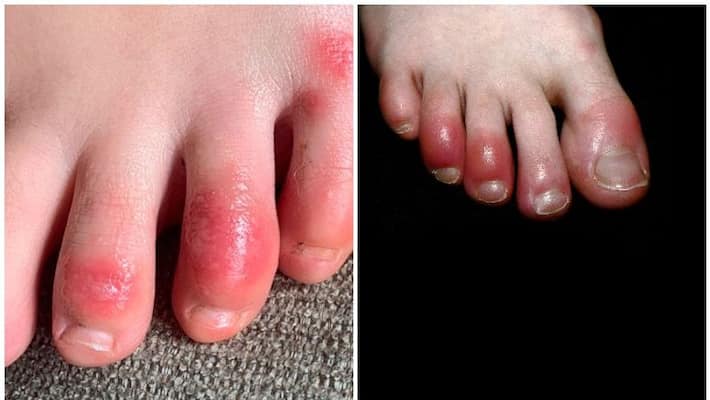 Immune System Overreaction May Cause 'Covid Toes' Immune System Overreaction May Cause 'Covid Toes'