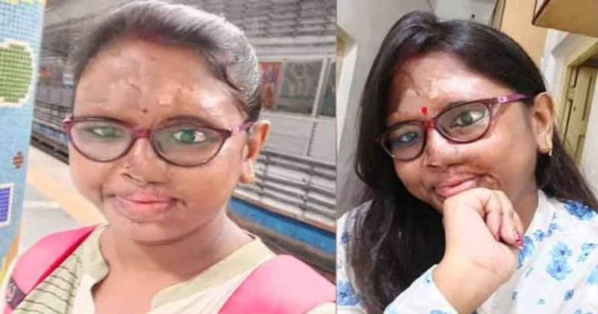 മുഖത്തേക്ക് ആസിഡൊഴിച്ചു, മുഖം പൊള്ളിയടർന്നു, എന്നാൽ ജീവിതത്തിൽ തോല്‍ക്കാതെ സഞ്ചയിത | life of acid attack survivor Sanchayita Yadav