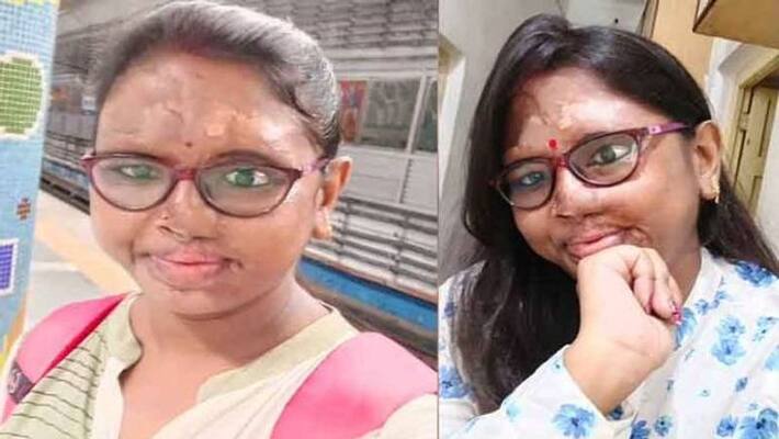life of acid attack survivor Sanchayita Yadav life of acid attack survivor Sanchayita Yadav