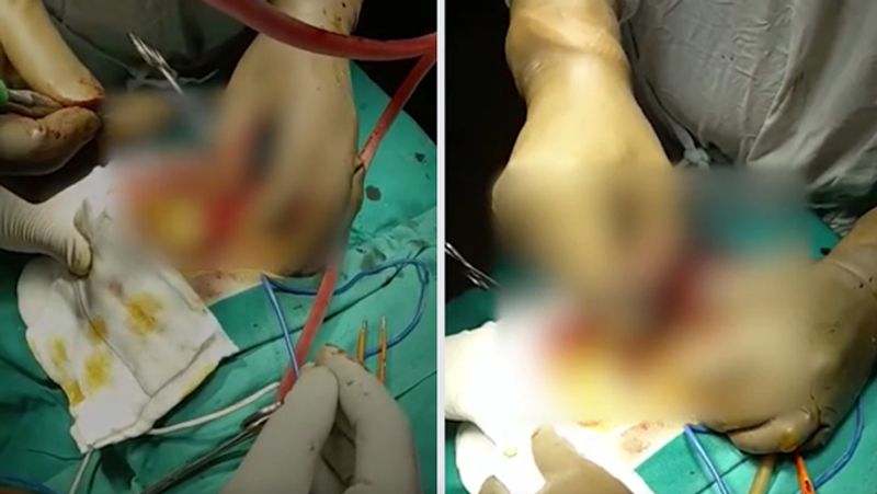 Madhya Pradesh, Doctors in Bhopal save woman life who had got an axe stuck in her head
