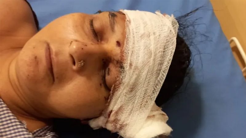 Madhya Pradesh, Doctors in Bhopal save woman life who had got an axe stuck in her head