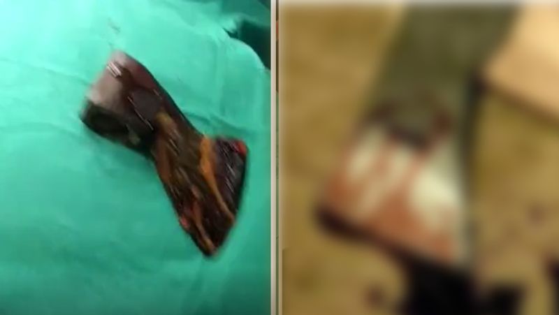 Madhya Pradesh, Doctors in Bhopal save woman life who had got an axe stuck in her head