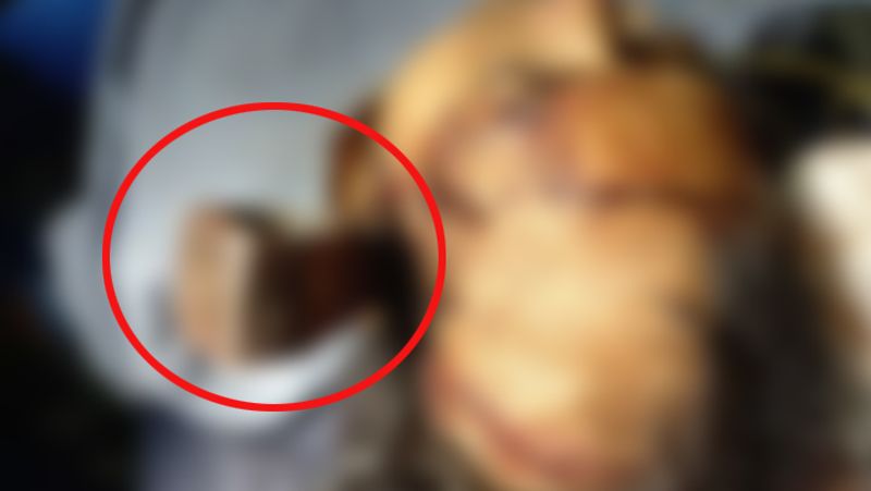 Madhya Pradesh, Doctors in Bhopal save woman life who had got an axe stuck in her head