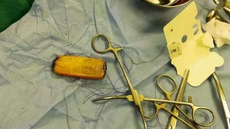 Egypt man kept a mobile in his stomach for 6 months
