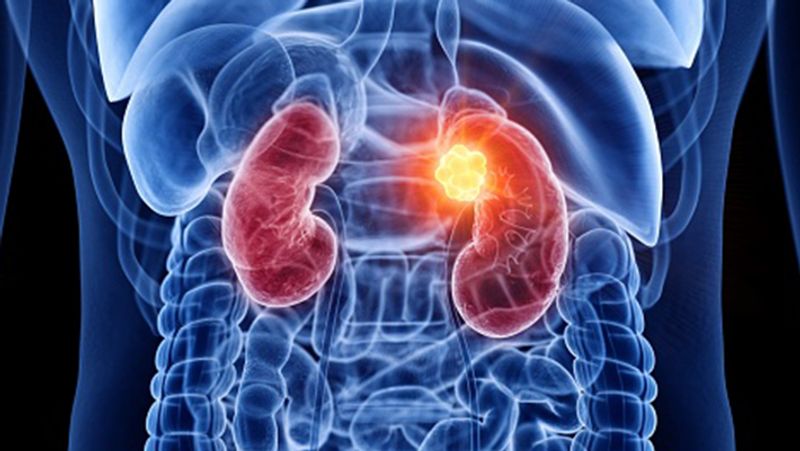 Gujarat doctor had removed kidney instead of the stone now he had pay a compensation of Rs 11 lakh