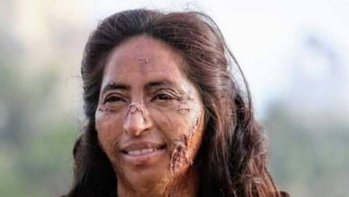 Daulat Bi Khan positive story of an acid attack survivor Daulat Bi Khan positive story of an acid attack survivor