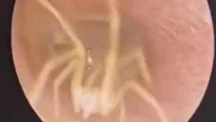 spider living in woman's ear spider living in woman's ear