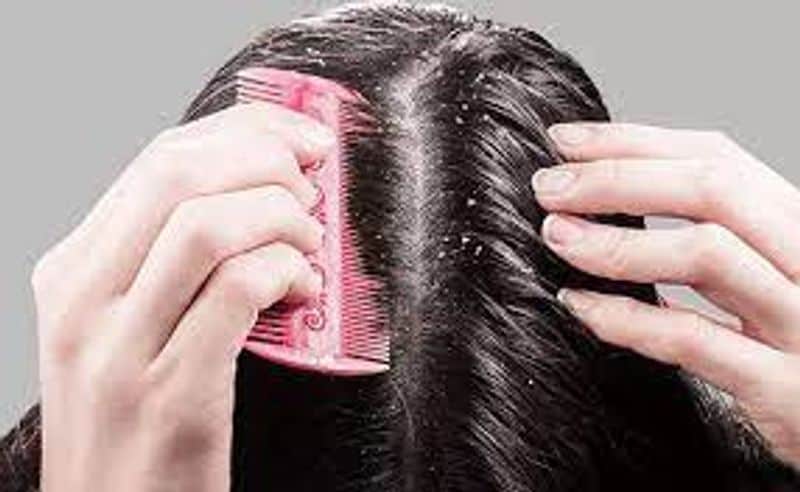 Try this natural hair pack for one time a week to get rid of dandruff full details here