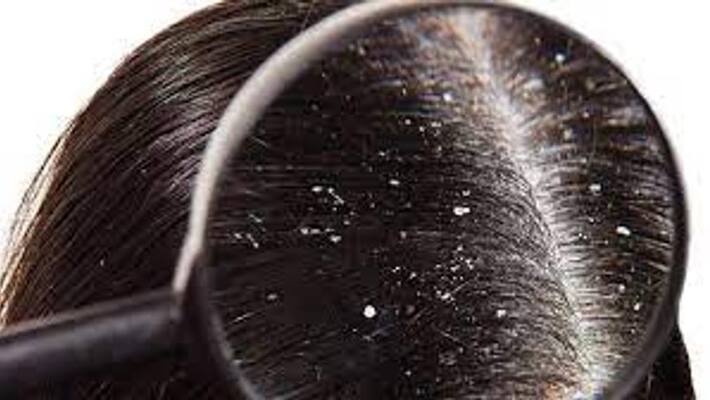 Effective garlic to get rid of dandruff know how to use BDD Effective garlic to get rid of dandruff know how to use BDD