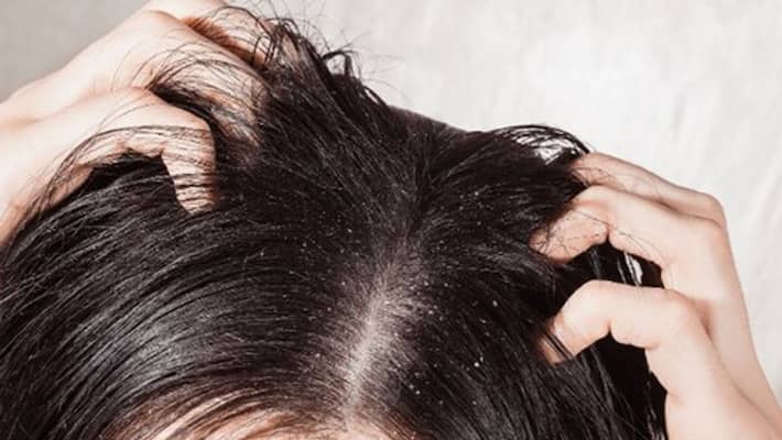 home remedies for dandruff home remedies for dandruff